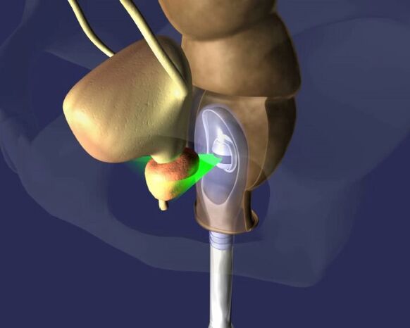 impactul ultrasunetelor asupra prostatei cu prostatita
