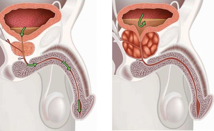 rezervați o metodă de tratare a prostatitei rădăcină galangă și prostatita