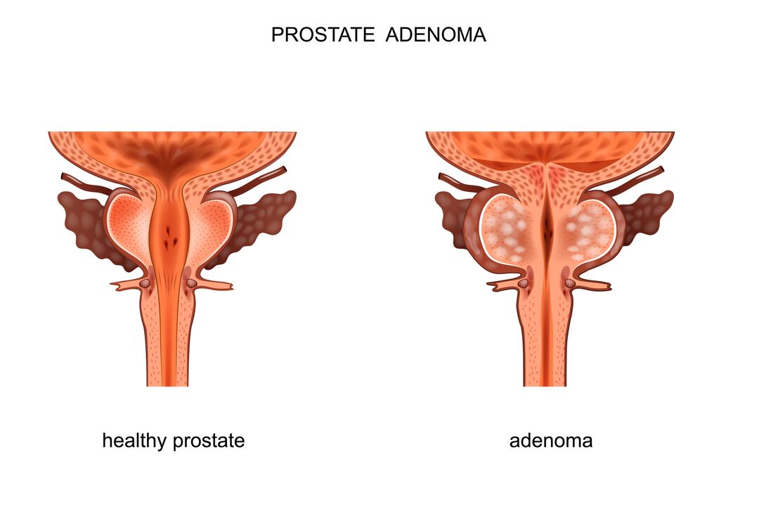 prostată sănătoasă și cu adenom